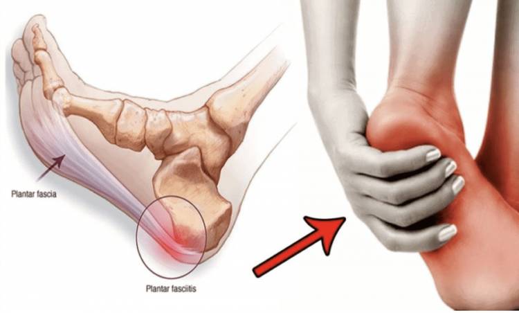 The Ultimate Guide to the Best Insoles for Plantar Fasciitis