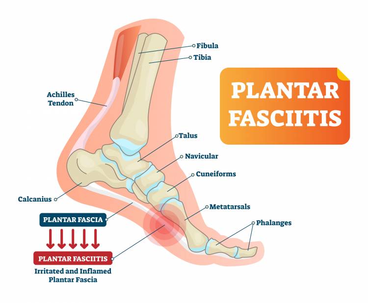 The Ultimate Guide to the Best Insoles for Plantar Fasciitis