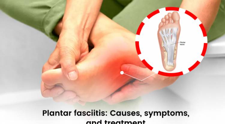 The Ultimate Guide to the Best Insoles for Plantar Fasciitis