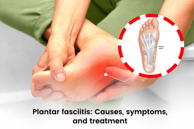 The Ultimate Guide to the Best Insoles for Plantar Fasciitis